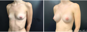 breast-augmentation-sugery-nyc-before-after-3-5