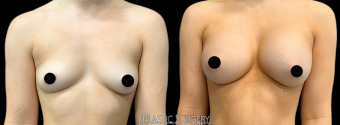 es-breast-augmentation-plastic-surgery-nyc-before-after-1-1