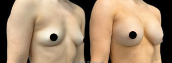 es-breast-augmentation-plastic-surgery-nyc-before-after-1-2