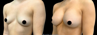 es-breast-augmentation-plastic-surgery-nyc-before-after-1-3