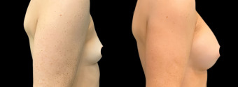 es-breast-augmentation-plastic-surgery-nyc-before-after-1-4