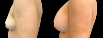 es-breast-augmentation-plastic-surgery-nyc-before-after-1-5