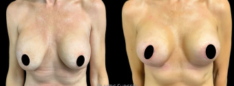 jv-breast-augmentation-plastic-surgery-nyc-before-after-1-1