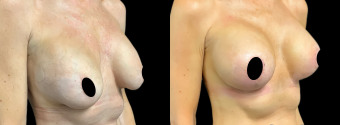 jv-breast-augmentation-plastic-surgery-nyc-before-after-1-2