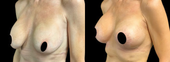 jv-breast-augmentation-plastic-surgery-nyc-before-after-1-3