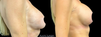 jv-breast-augmentation-plastic-surgery-nyc-before-after-1-4