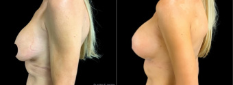 jv-breast-augmentation-plastic-surgery-nyc-before-after-1-5