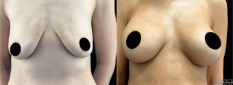 ra-breast-augmentation-plastic-surgery-nyc-before-after-1-1