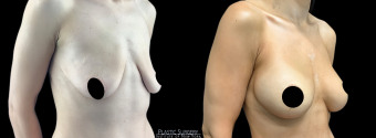 ra-breast-augmentation-plastic-surgery-nyc-before-after-1-2