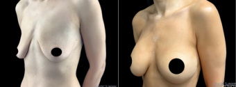 ra-breast-augmentation-plastic-surgery-nyc-before-after-1-3