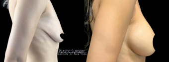 ra-breast-augmentation-plastic-surgery-nyc-before-after-1-4