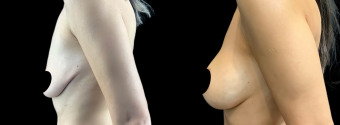 ra-breast-augmentation-plastic-surgery-nyc-before-after-1-5
