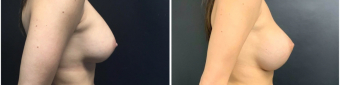 breast-implants-exchange-sugery-nyc-before-after-1-2