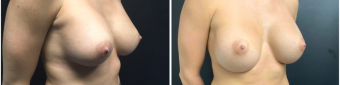 breast-implants-exchange-sugery-nyc-before-after-1-4