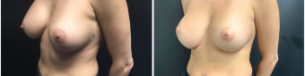 breast-implants-exchange-sugery-nyc-before-after-1-5