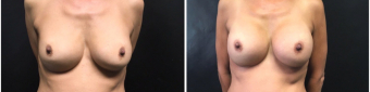 breast-implants-exchange-sugery-nyc-before-after-2-1