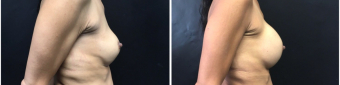 breast-implants-exchange-sugery-nyc-before-after-2-2