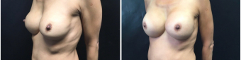 breast-implants-exchange-sugery-nyc-before-after-2-5