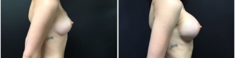 breast-implants-exchange-sugery-nyc-before-after-3-2