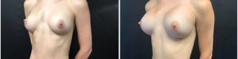 breast-implants-exchange-sugery-nyc-before-after-3-4