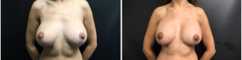 breast-implants-exchange-sugery-nyc-before-after-4-1