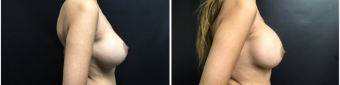 breast-implants-exchange-sugery-nyc-before-after-4-2