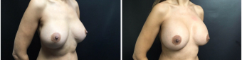 breast-implants-exchange-sugery-nyc-before-after-4-4