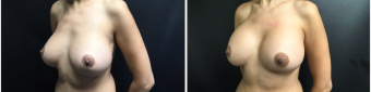 breast-implants-exchange-sugery-nyc-before-after-4-5