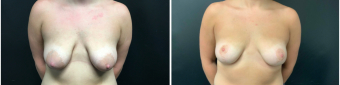 breast-lift-surgery-nyc-before-after-1-1