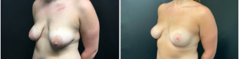 breast-lift-surgery-nyc-before-after-1-2