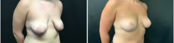 breast-lift-surgery-nyc-before-after-1-3