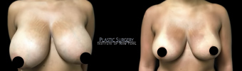 br-breast-reduction-plastic-surgery-nyc-before-after-1-1