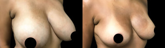 br-breast-reduction-plastic-surgery-nyc-before-after-1-2