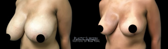 br-breast-reduction-plastic-surgery-nyc-before-after-1-3