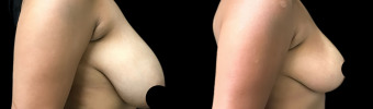 br-breast-reduction-plastic-surgery-nyc-before-after-1-4