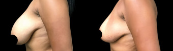 br-breast-reduction-plastic-surgery-nyc-before-after-1-5