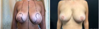 breast-reduction-surgery-nyc-before-after-1-1