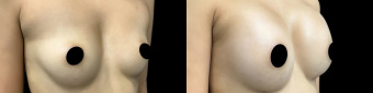 pg-breast-augmentation-plastic-surgery-nyc-before-after-1-2