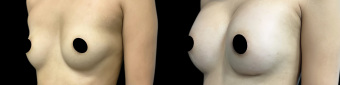 pg-breast-augmentation-plastic-surgery-nyc-before-after-1-3