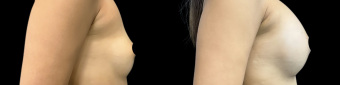 pg-breast-augmentation-plastic-surgery-nyc-before-after-1-4