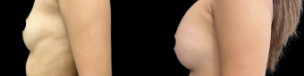 pg-breast-augmentation-plastic-surgery-nyc-before-after-1-5