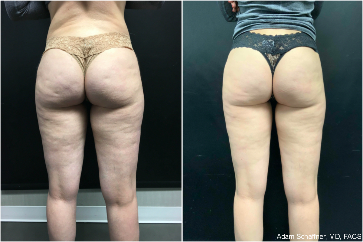 cellulite-treatment-nyc-before-after-1-1