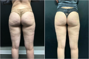 cellulite-treatment-nyc-before-after-1-1