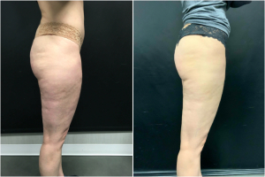 cellulite-treatment-nyc-before-after-1-2