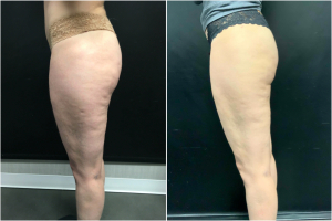 cellulite-treatment-nyc-before-after-1-3