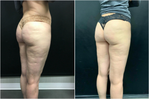 cellulite-treatment-nyc-before-after-1-4