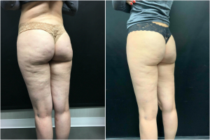 cellulite-treatment-nyc-before-after-1-5