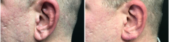 earlobe-repair-surgery-nyc-before-after-1-2
