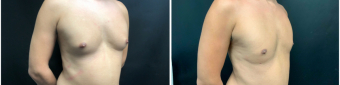 gynecomastia-liposuction-sugery-nyc-before-after-1-4