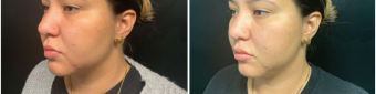 lip-enhancement-nyc-before-after-1-2